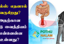 Piles Treatment in Tamil