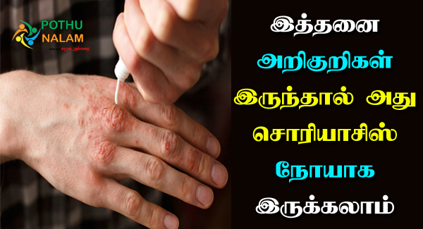 Psoriasis Symptoms in Tamil