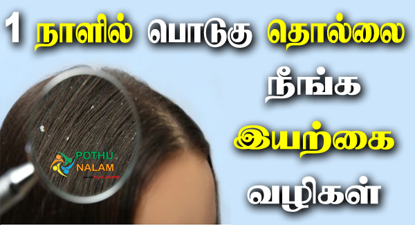 பொடுகு தொல்லை நீங்க இயற்கை வழிகள் | Dandruff Home Remedies in Tamil