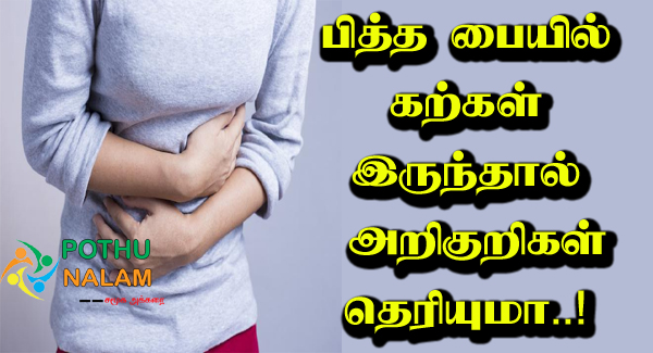 Symptoms of Gallstones in Tamil