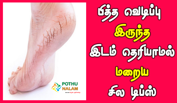 Cracked Heels Treatment in Tamil