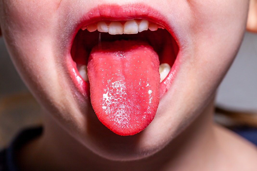 tongue colour symptoms in tamil