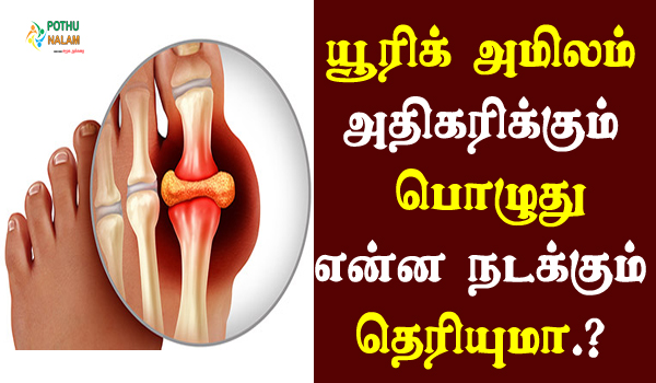 uric acid symptoms in tamil