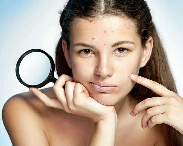 Home remedy for pimples and dark spots in tamil