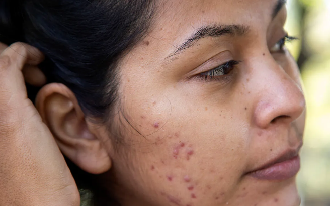 How to remove pimple marks naturally at home in tamil