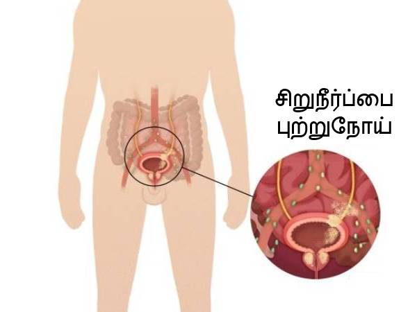 Bladder Cancer Symptoms Tamil