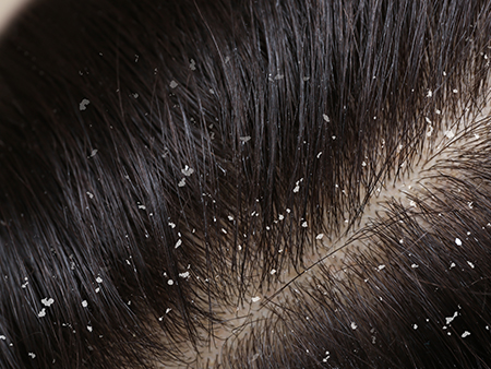 How to Remove Dandruff Permanently in Tamil