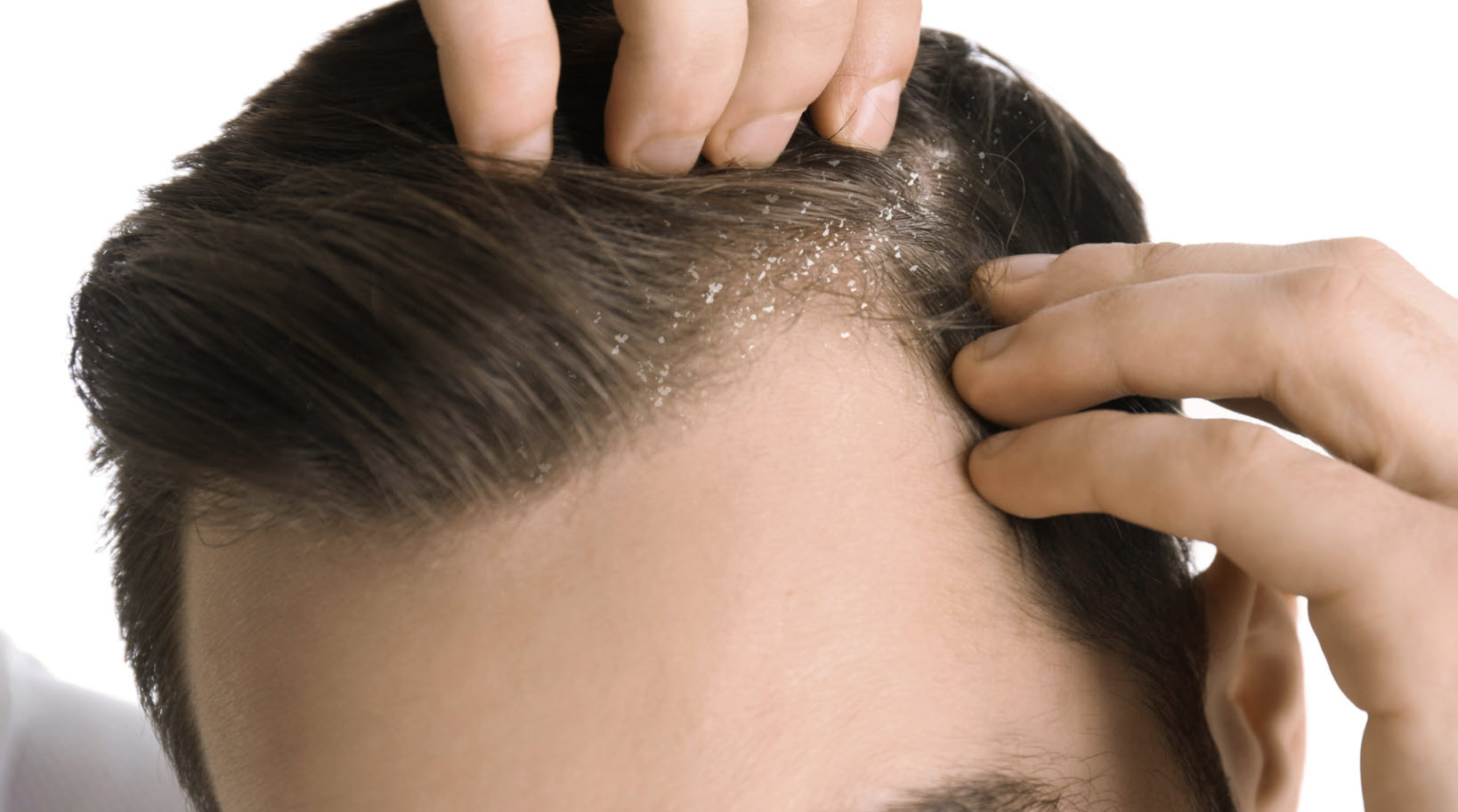 How to Remove Dandruff Quickly in Tamil