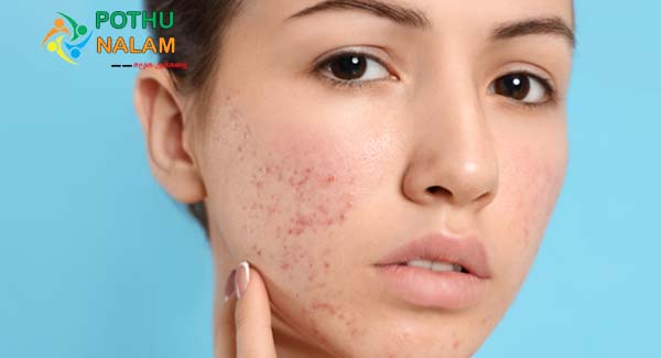 face pimples remove tips tamil