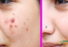 Face Pimples Remove Tips in tamil