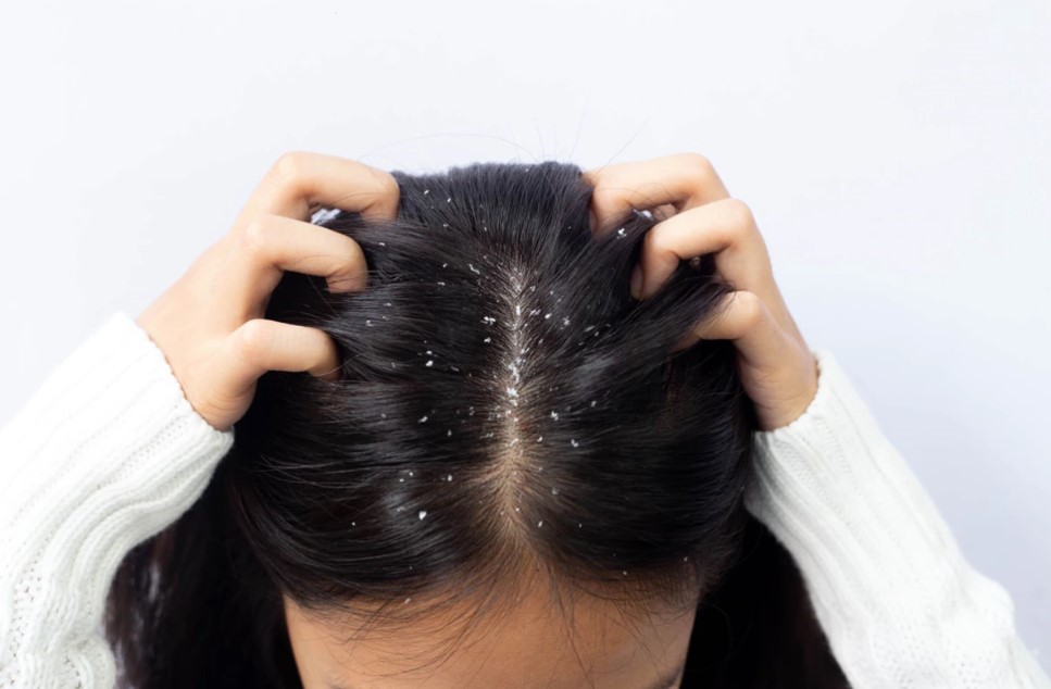 How to Cure Dandruff Permanently in Tamil