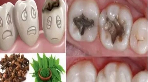 How to Heal Cavities Naturally at Home in Tamil