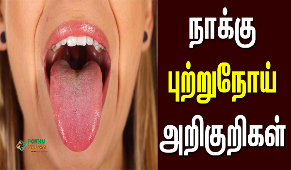 Tongue Cancer Symptoms in Tamil