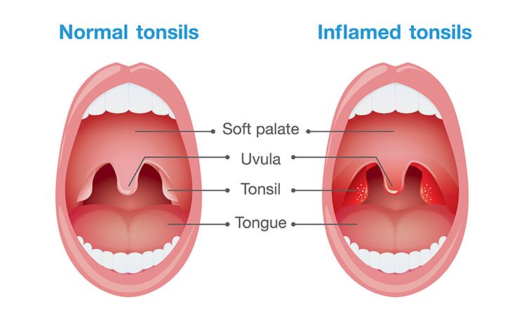 Tonsils Symptoms in Tamil
