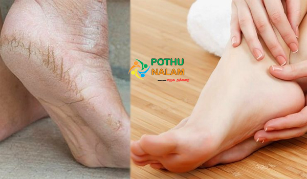 cracked heels treatment at home in tamil 
