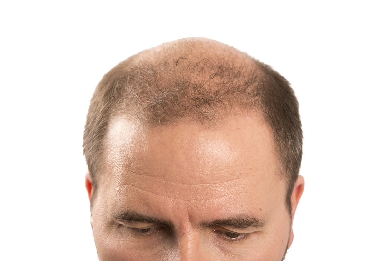 hair loss reasons for male