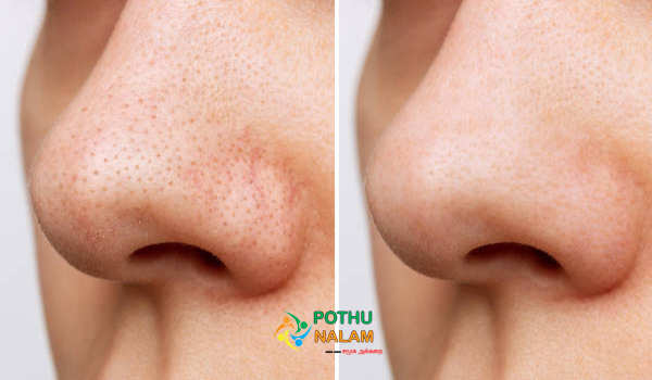 nose black mark remove tips in tamil