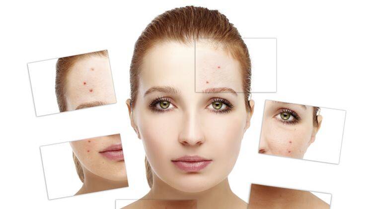 Home Remedies to Clear Acne in 2 Days in Tamil