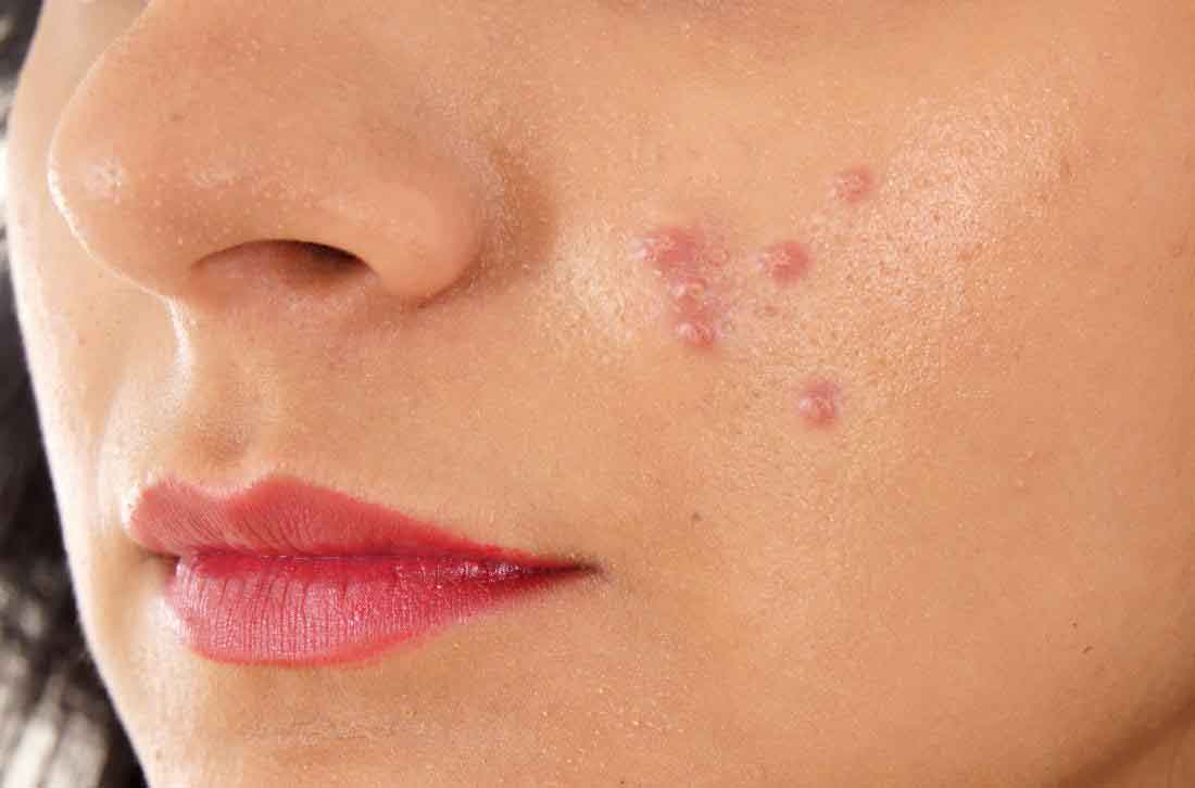 How to Remove Pimples Naturally at Home in Tamil