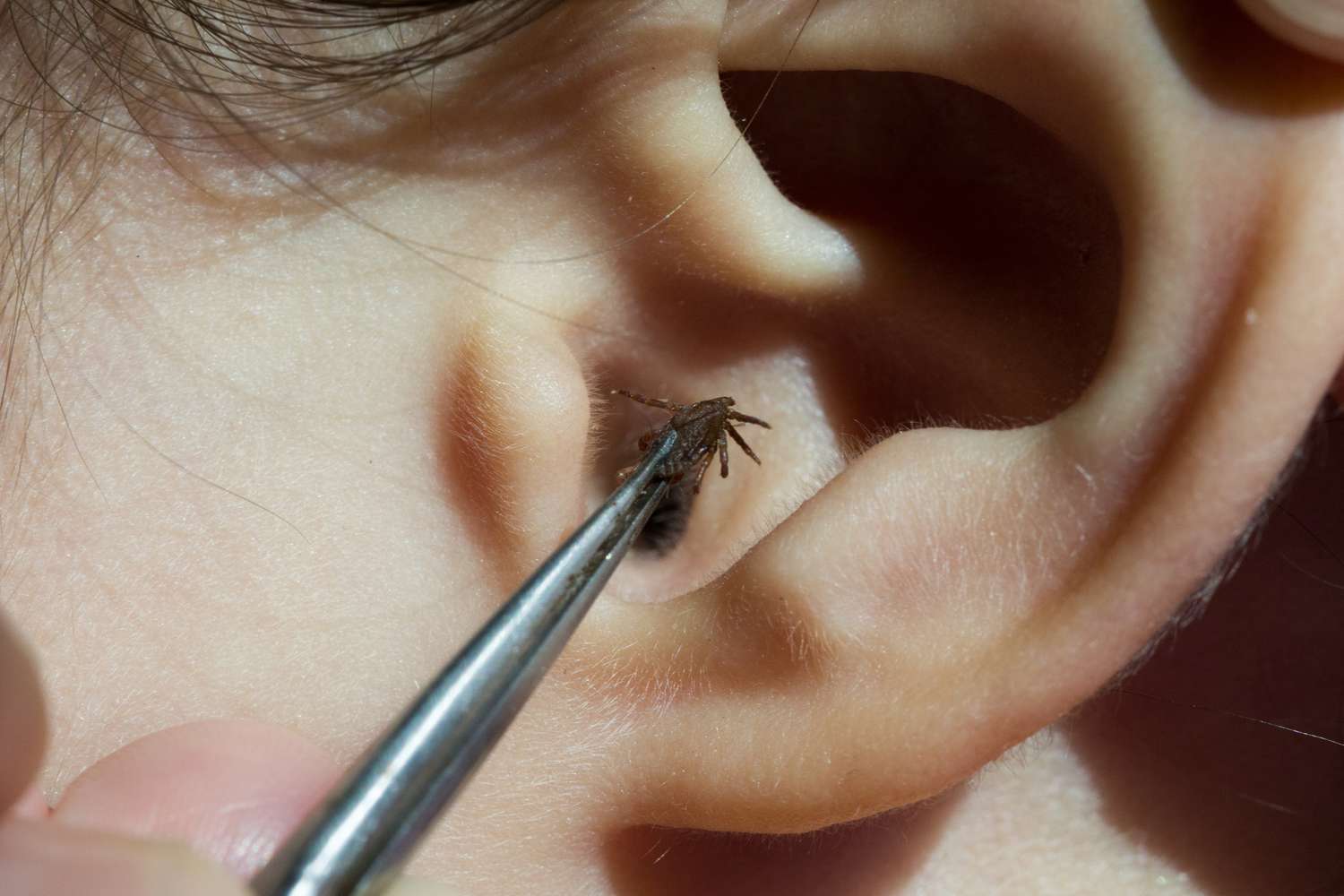 If a live insect enters the ear first aid