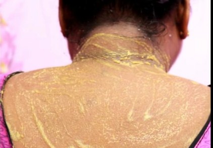  neck darkness removal home remedy in tamil