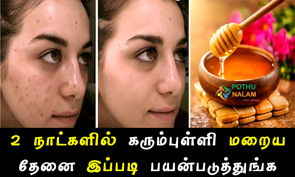 Home Remedies For Pimple Marks in Tamil