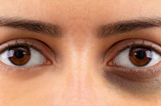 How to Remove Dark Circles Under Eyes Permanently in Tamil