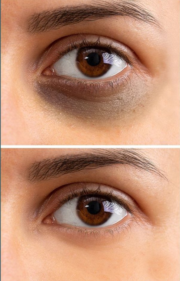 How to Remove Dark Circles at Home Naturally in Tamil