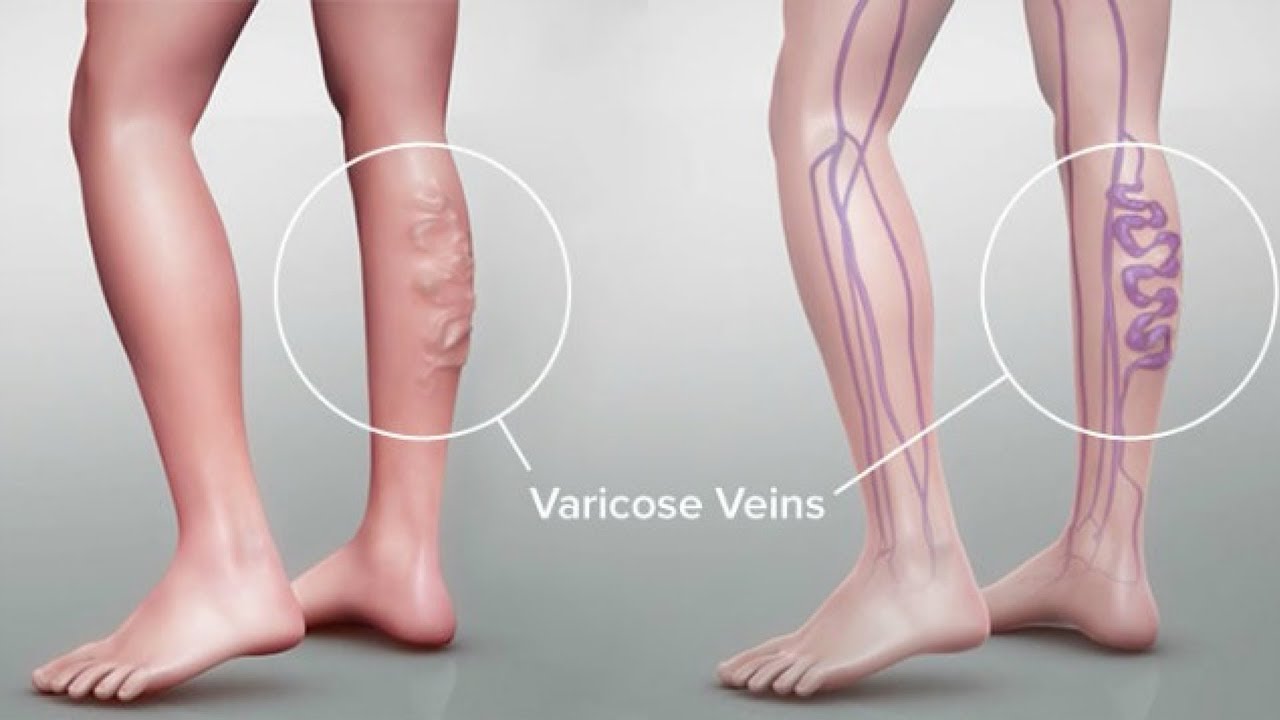 varicose veins symptoms