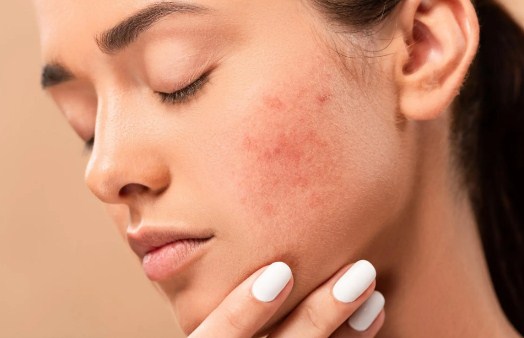 How To Remove Dark Skin Spots on Face in Tamil