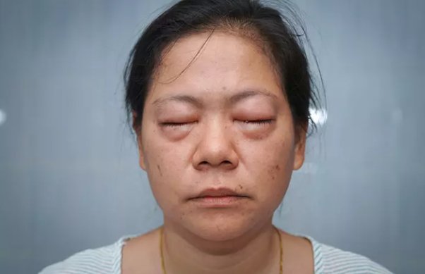 What is The Symptoms of Face Swelling in Tamil