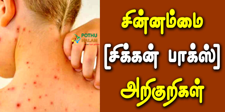 Chicken Pox Symptoms in Tamil