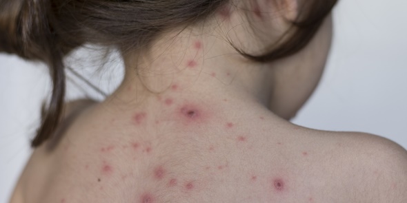 What is Chicken Pox in Tamil