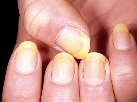 health symtoms in nail